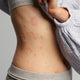 Body of a lady with eczema and blemishes