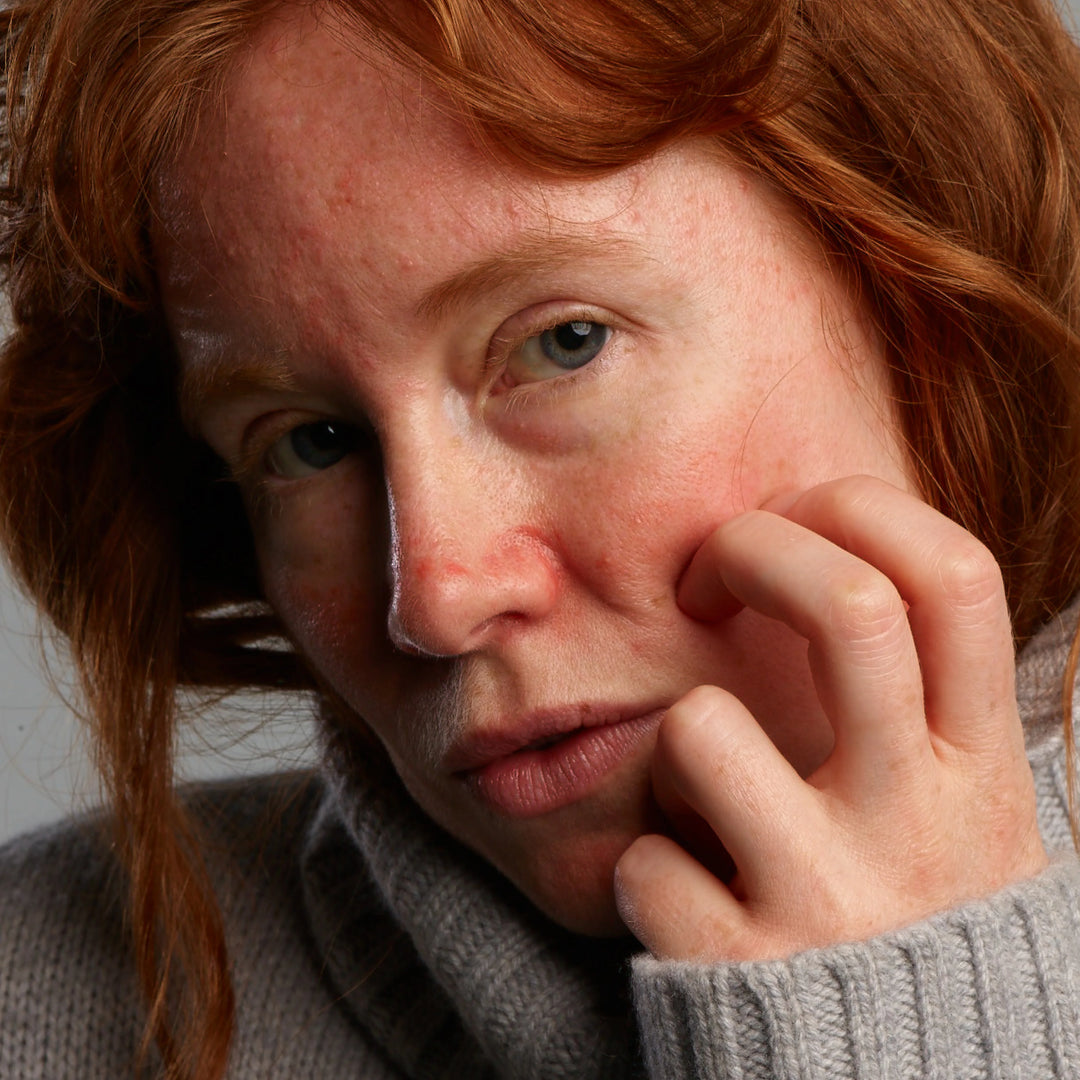 Lady affected by rosacea with red skin