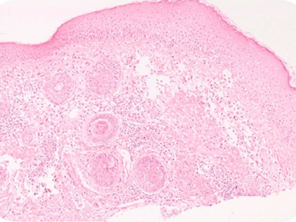 Rosacea Types, Triggers and Treatment Options