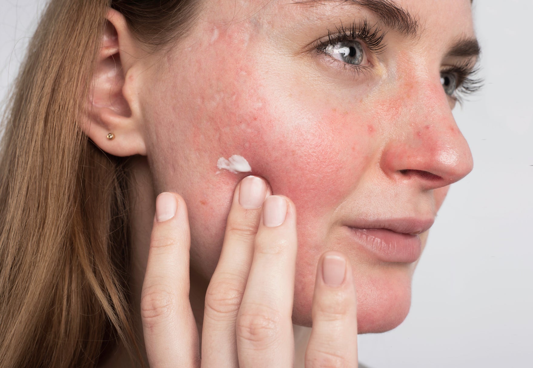 April Is Rosacea Awareness Month