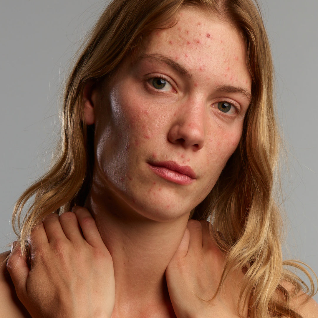 Lady with acne on the face